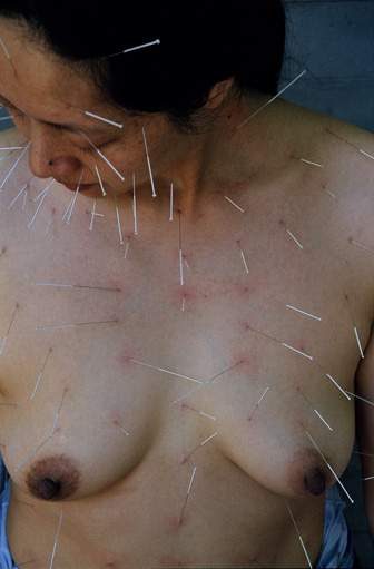 «99 Needles», 2002